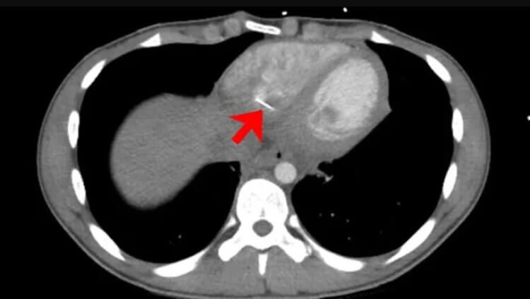 Может ли иголка добраться до сердца? Реальный случай